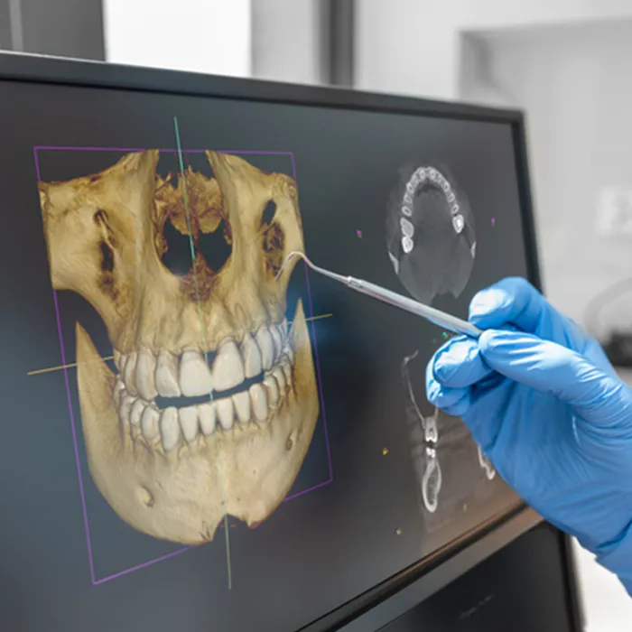Visualizzazione CBCT 3D per la pianificazione implantare