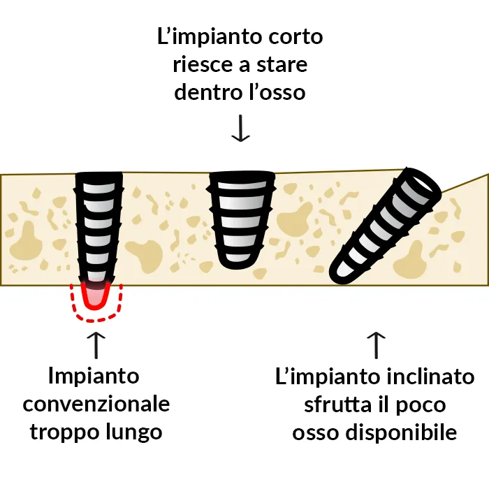 Esempio di impianti corti e inclinati