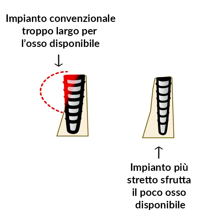 Esempio di impianti a diametro ridotto