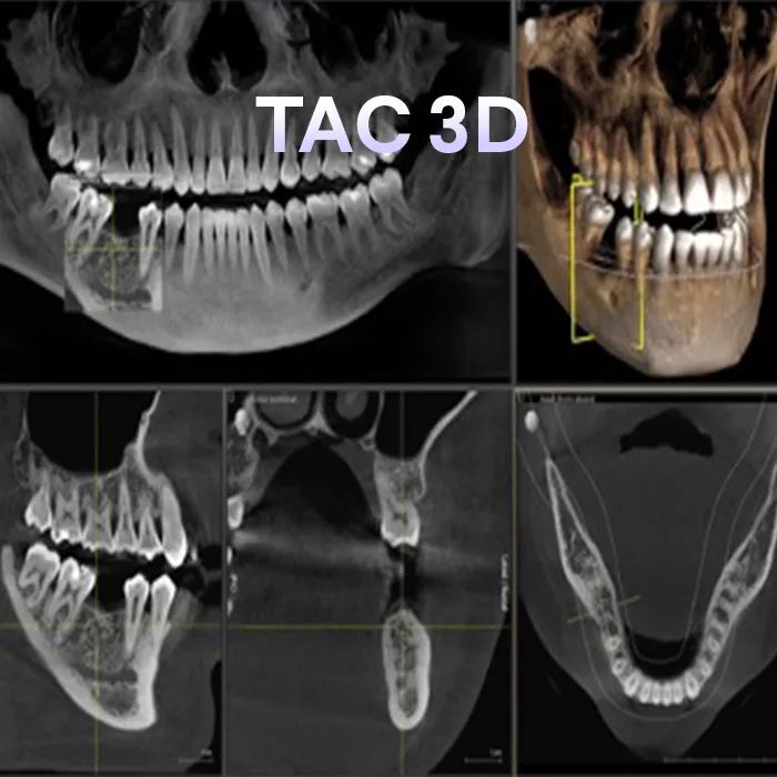 Esempio di TAC 3D per la pianificazione implantologica