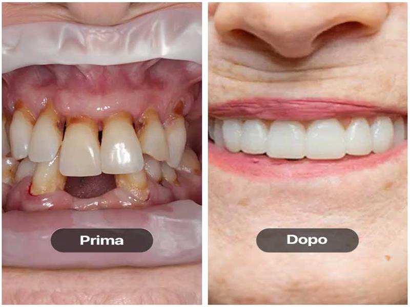 Prima e dopo l'impianto di protesi nuove per paziente con caso clinico complicato